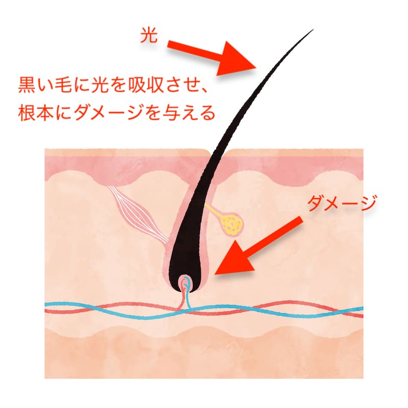 毛の根元にダメージを与える。