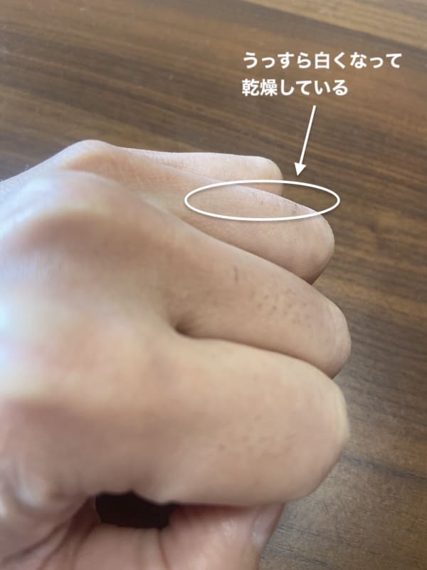 レベル7で照射(2日後)した手の指を横から見ると薬指が白くなって乾燥している